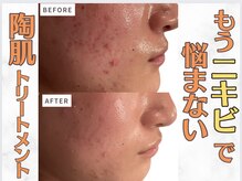 アンノン(Annon)の雰囲気（剥けないハーブピーリングでニキビ肌を徹底改善☆）