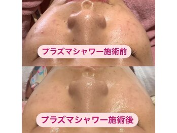 メディカルサロン ティアラ 亀有本店/【プラズマシャワー】