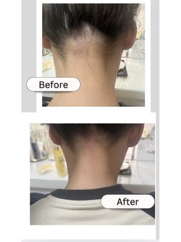 ミナミ/うなじ脱毛!