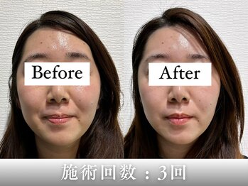 フラット(flat)の写真/むくみ・食いしばり・もたつきに◎美顔器「セルキュア」×電気を流す小顔美容鍼で即すっきり | 初回 7200円