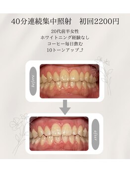 プラスビーセルフ(+b self)/ホワイトニングビフォーアフター