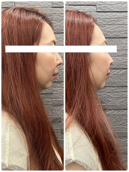 長寿鍼灸院 長寿整骨院/美容鍼50本の効果★小顔効果