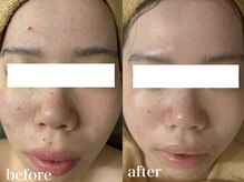 ホワイトアクア 北千住店(WHITE AQUA)/ハーブピーリング5ヶ月変化