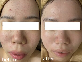 ホワイトアクア 北千住店(WHITE AQUA)/ハーブピーリング5ヶ月変化