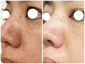 アニュー(anew.)/【Lit症例】フェイシャル