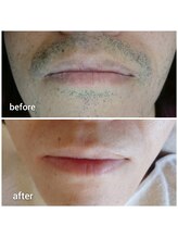 シックワークス オット(Chic Work's Otto)/ヒゲ脱毛で清潔感&好感度UP！