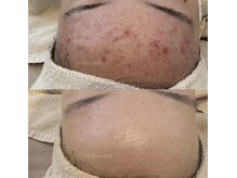 ルブドワール(Le Boudoir)/20代お客様before→after