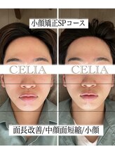 セリア(CELIA)/メンズ小顔矯正　メンズ小顔