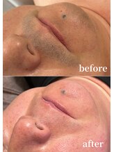 スピカ(Spica) ヒゲ 脱毛