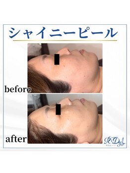 デール(R:DeeL)/シャイニーピール