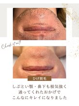 ヒーリングリゾート ナゴミ(Nagomi)/ひげ脱毛