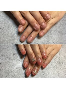 アルーア(Allure)/深爪ケア施術前→施術後