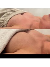 メゾン アンジュ(Maison Ange)/バストアップ症例／育乳／バスト