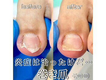 新宿巻き爪補正店/