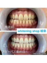 ホワイトニングショップ 岐阜駅前/#岐阜ホワイトニング#岐阜エステ