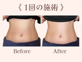 ナチュモア(natyumoi)/【1回施術前後】生理不調も軽減