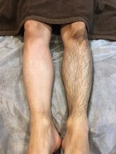 トリプルワン(111)/メンズボディWAX脱毛