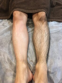 トリプルワン(111)/メンズボディWAX脱毛