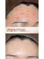ソワ 吉塚店(soi)&nbsp;肌質改善 ニキビケア