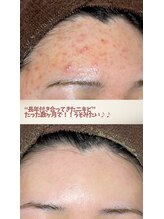 ソワ 吉塚店(soi)&nbsp;肌質改善 ニキビケア