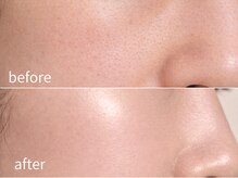 ソレイユ(Soleil)/毛穴・角質ケア