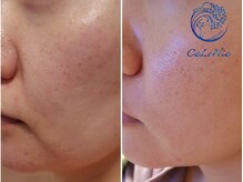 カロニア(CaLoNia)/たるみケア・ほうれい線解消☆