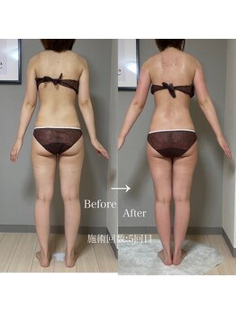 エヌボーテ(N. beaute)/全身痩身4回追加コース