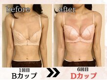 プリマ(prima)/バストアップ症例