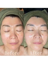 ボッカ(bocca)/水光肌乳酸菌ピーリング