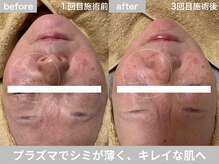 サロン ビュー(salon view)/70代女性〈シミ悩み〉　