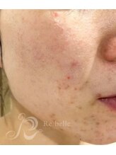 リン 長崎 大村(Rin)/before