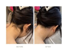 エルピス(ELPIS)/うなじMIX脱毛