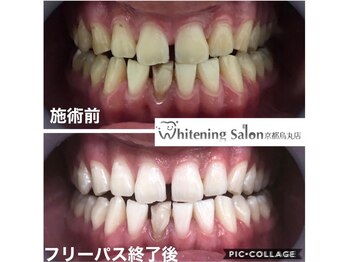 ホワイトニングサロン 京都烏丸店/ホワイトニング施術例