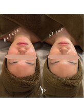 アピュルテ(A purete')/ハーブピーリング Before→After