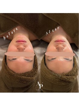 アピュルテ(A purete')/ハーブピーリング Before→After