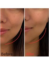 モアビューティー 紙屋町店/即実感！リフトアップ！