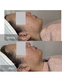 カノン(Kanon)/レモンボトル×幹細胞7%