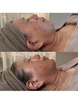 エステサロン マコ(MaCo)/50代・シワ/たるみ改善