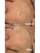 ニコ(nico)/ニキビ・黒ずみ毛穴とおさらば。