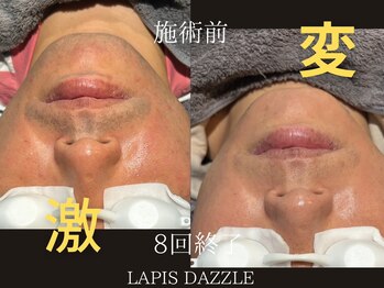 ラピスダズル(LAPIS DAZZLE)/ヒゲ脱毛★途中経過