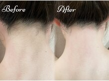 ピミル(PIMIL)/うなじ脱毛