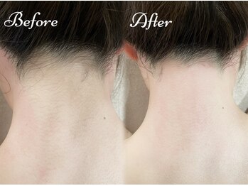 ピミル(PIMIL)/うなじ脱毛