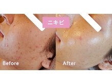 ナナラ(nanala)/OHLハーブピーリング