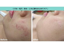 初めてでも安心◎ 肌に優しい光フェイシャル♪