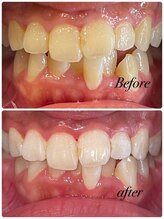 ビューティーケア(beauty care)/ホワイトニング×ホワイトニング