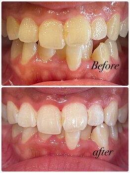 ビューティーケア(beauty care)/ホワイトニング×ホワイトニング