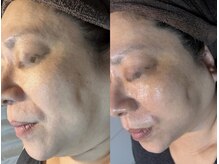 セルヴィノバ(CELL VI NOVA)/＊ビフォーアフター