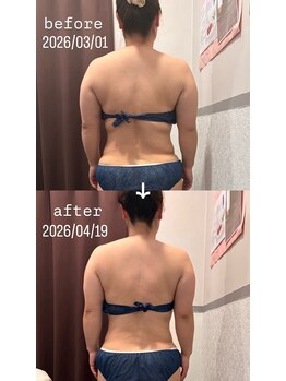 ビューティークローゼットアリー(Beauty closet Alii)の写真/【NEW!】背中～二の腕＆ウエスト集中痩身で夏本番までに代謝UPデトックス！理想の後ろ姿＆くびれボディへ◎