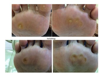 ドクターネイル爪革命 江戸川橋店/足裏なんでこんなに痛いの？