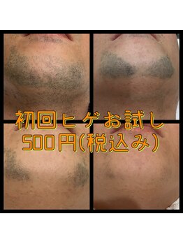 リアンジュ/髭脱毛の経過